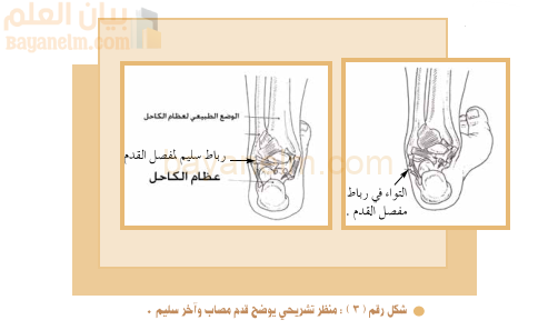 منظر تشريحي يوضح قدم مصاب واخر سليم